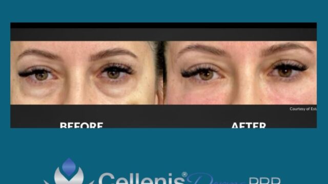 Copy-of-Derma-PRP-Marketing-Kit-DMK-37